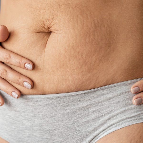 close-up-woman-with-stretch-marks